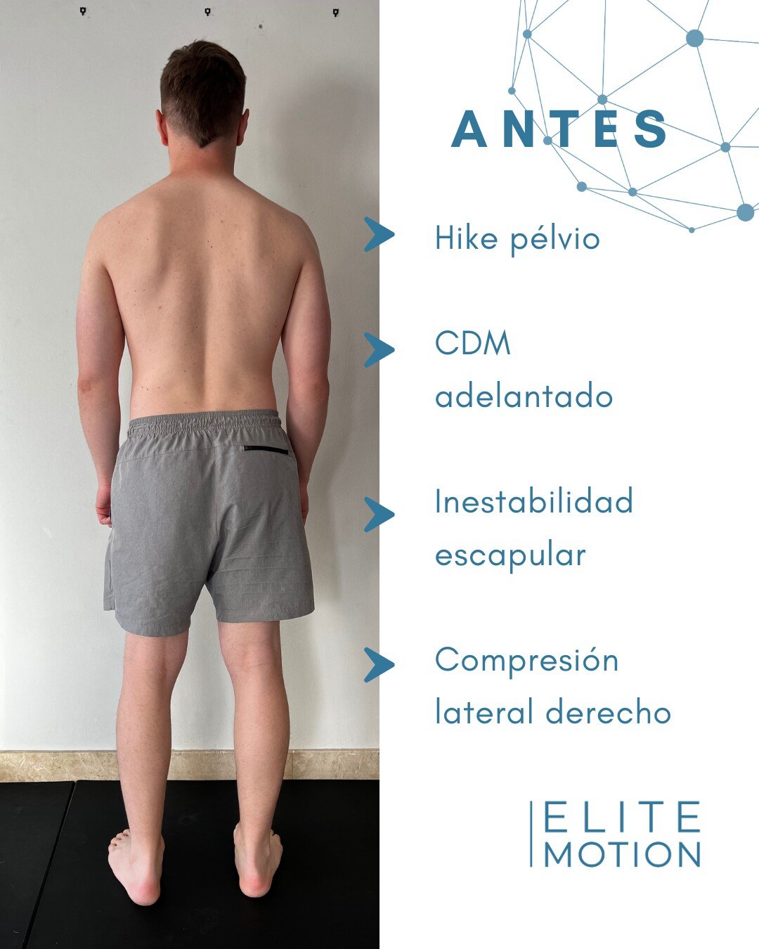 Alex antes: hike pélvico, CDM adelantado, inestabilidad escapular, compresión lateral derecho