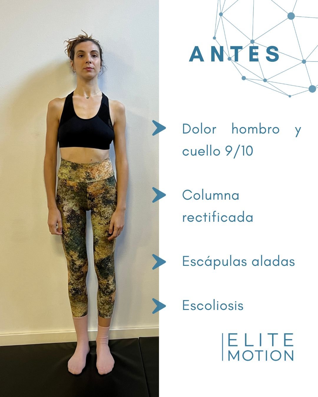 Patricia antes: dolor hombro y cuello 9/10, columna rectificada, escápulas aladas, escoliosis