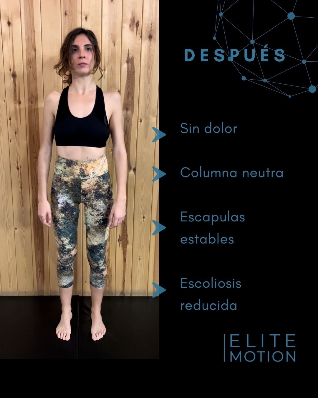 Patricia después: sin dolor, columna neutra, escápulas estables, escoliosis reducida
