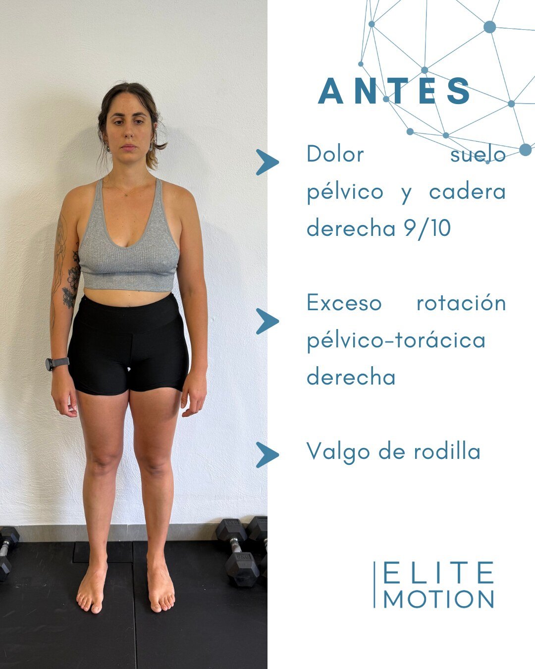 Victoria antes: dolor suelo pélvico y cadera derecha 9/10, exceso rotación pélvico-torácica derecha, valgo de rodilla