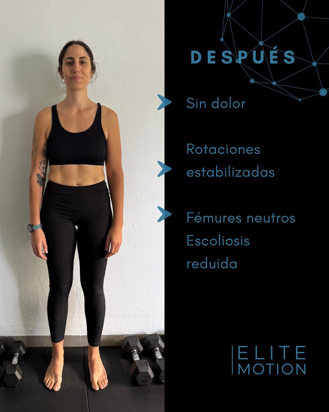 Victoria después: sin dolor, rotaciones estabilizadas, fémures neutros, escoliosis reducida